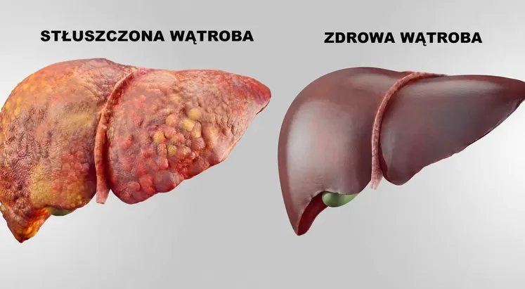 Stłuszczona wątroba obok zdrowej wątroby